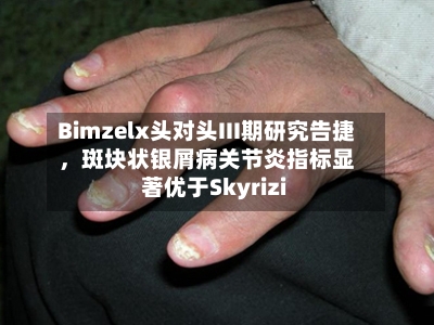 Bimzelx头对头III期研究告捷	，斑块状银屑病关节炎指标显著优于Skyrizi-第2张图片
