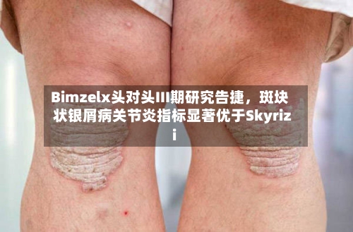 Bimzelx头对头III期研究告捷，斑块状银屑病关节炎指标显著优于Skyrizi-第3张图片
